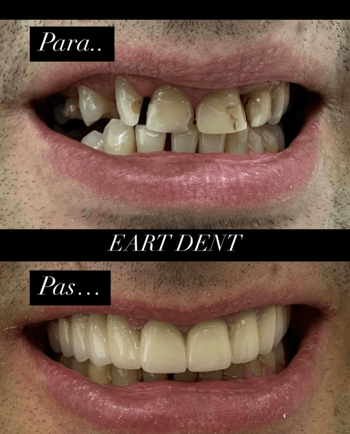 Eart dent - punime para pas 11