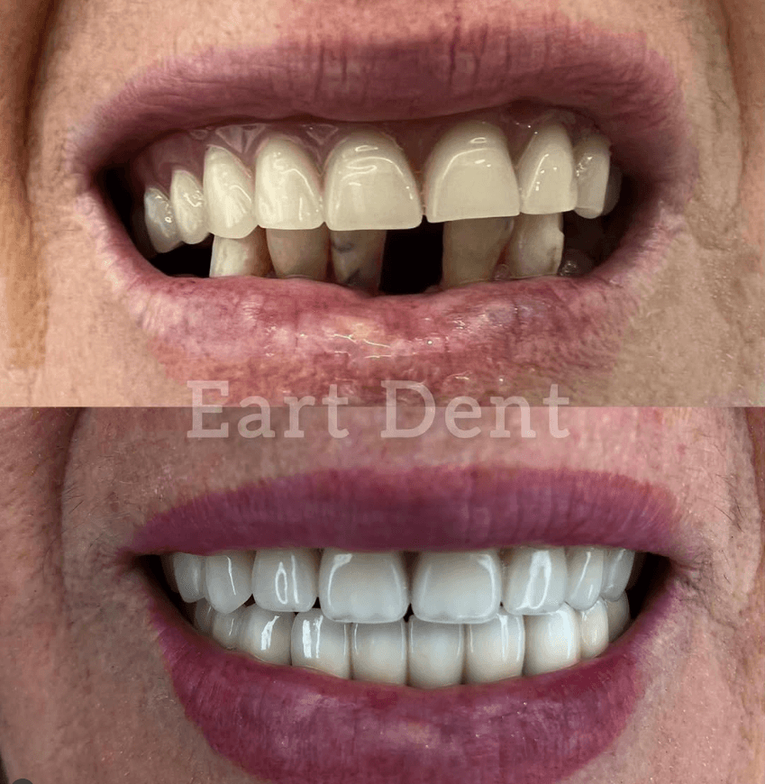 Eart dent - punime para pas 12