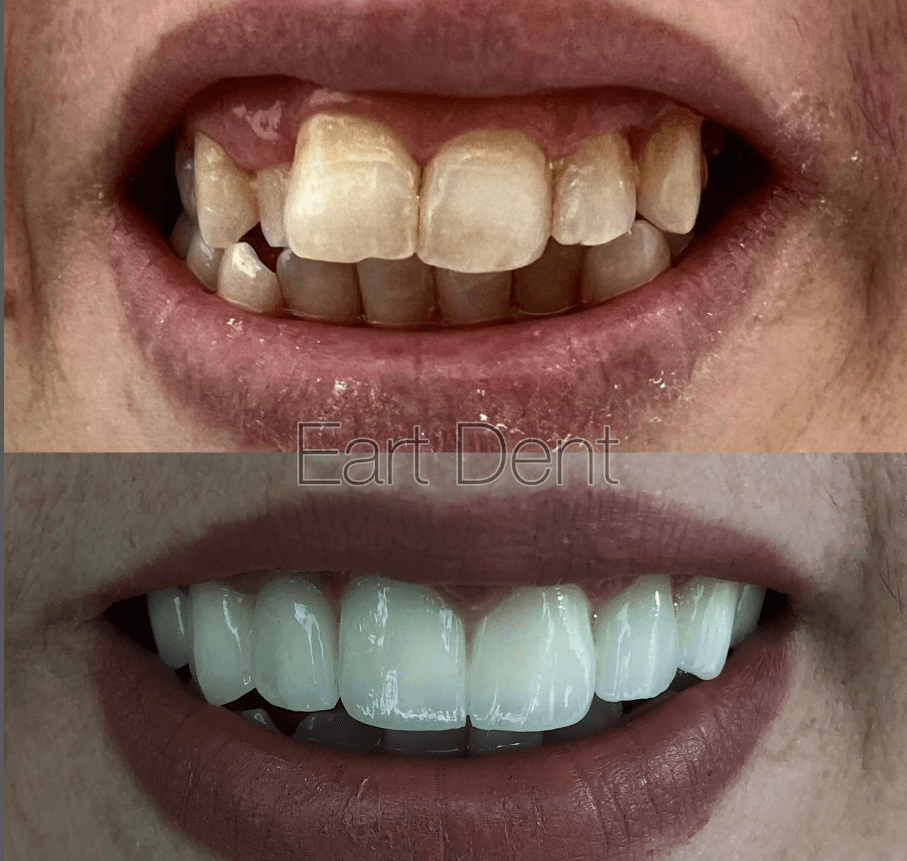 Klinike dentare durres - eart dent - punime para pas 13