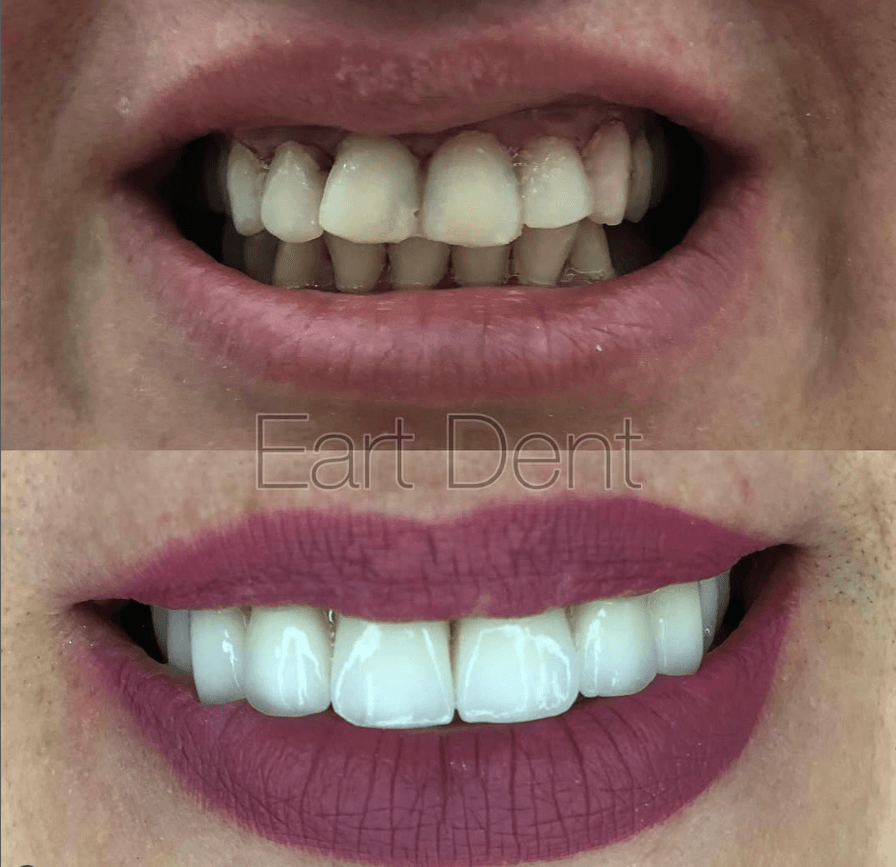Klinike dentare durres - eart dent - punime para pas 14
