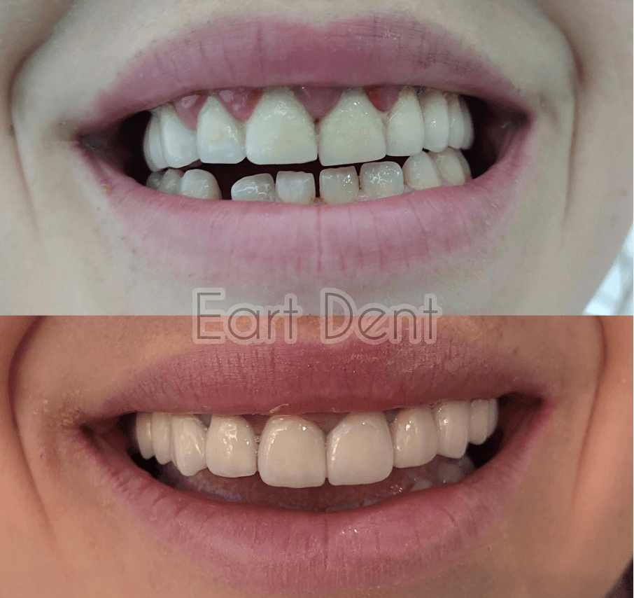 Klinike dentare durres - eart dent - punime para pas 15