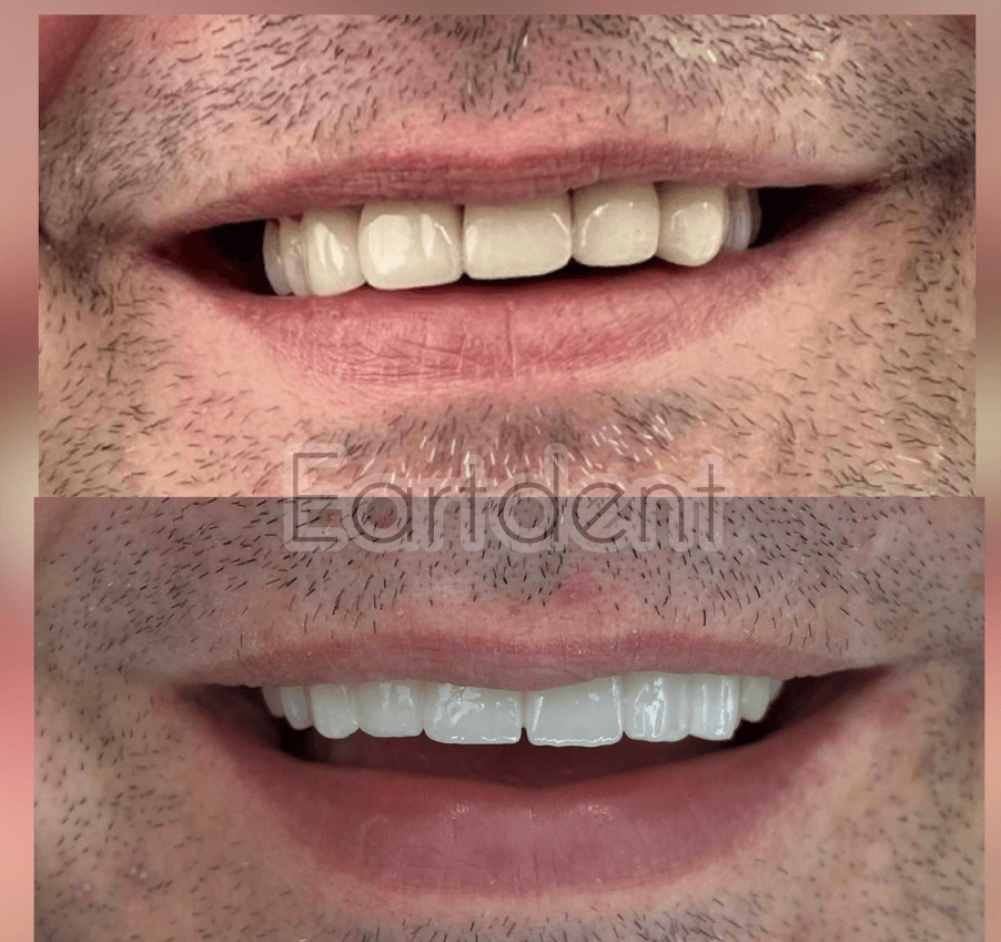 Klinike dentare durres - eart dent - punime para pas 16