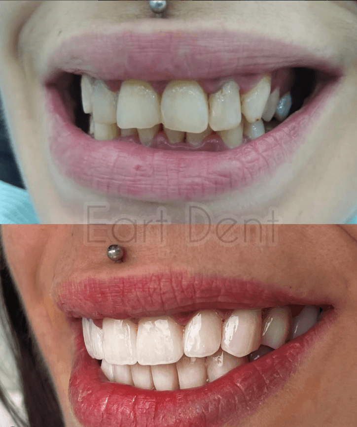 Klinike dentare durres - eart dent - punime para pas 17