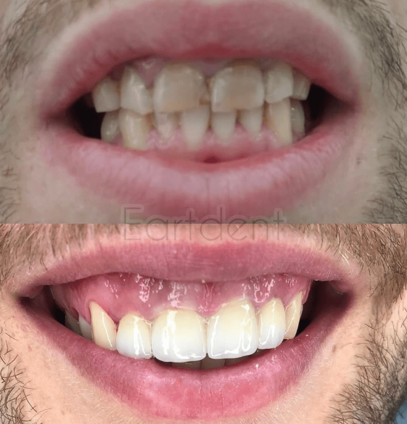 Klinike dentare durres - eart dent - punime para pas 19