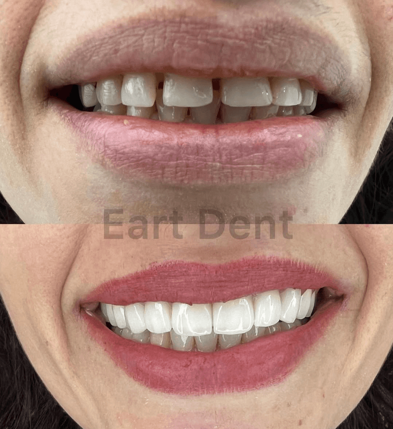 Eart dent - punime para pas 3