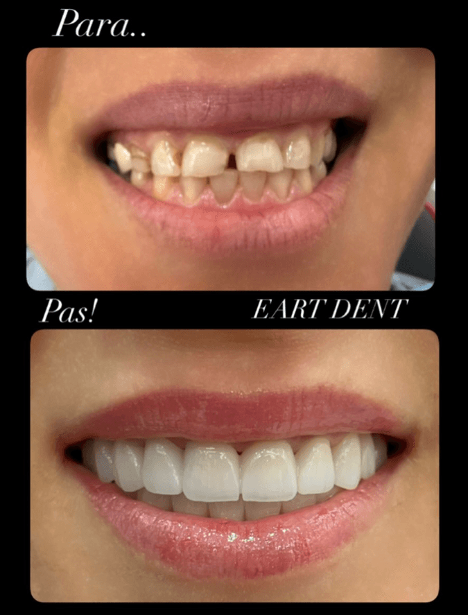 Eart dent - punime para pas 4