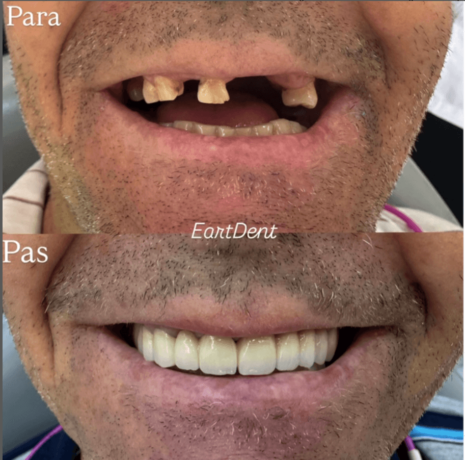 Eart dent - punime para pas 5