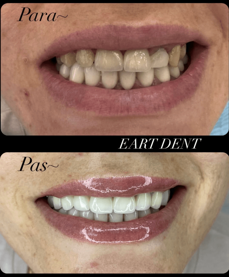 Eart dent - punime para pas 7