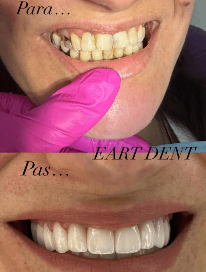 Eart dent - punime para pas 8