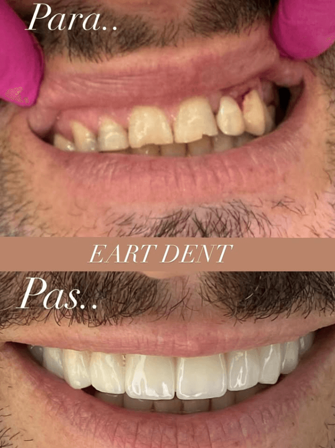 Eart dent - punime para pas 9