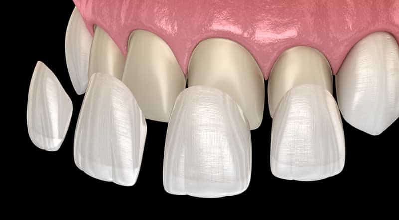 faseta emax durres- eart dent