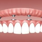 kirurgji dentare - implante dentare eart dent