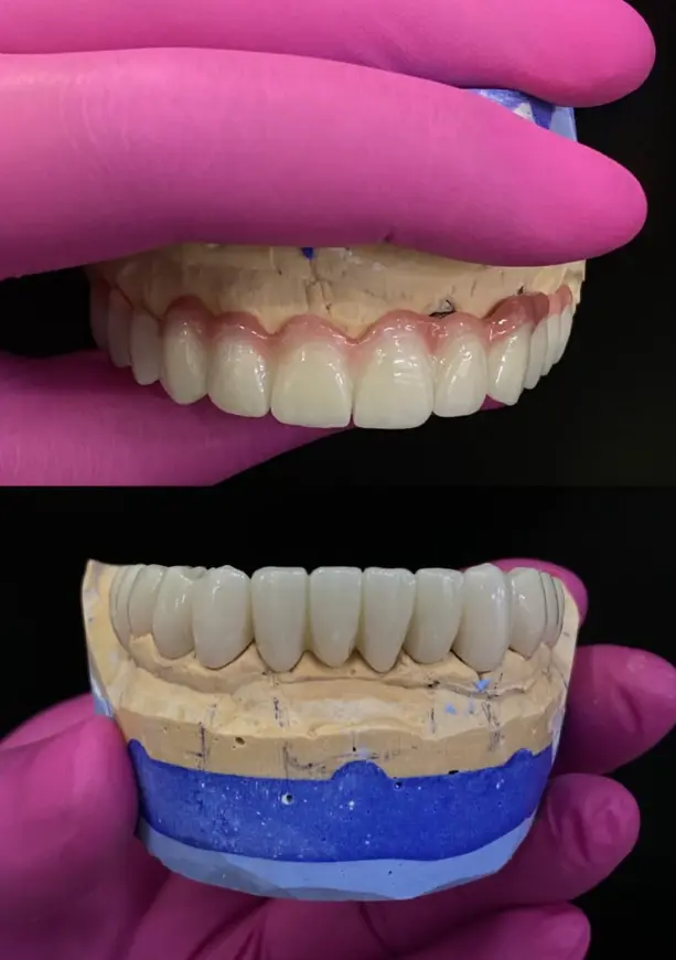 Kurore-zirkon-Eart-Dent-Klinike-Dentare-Durres