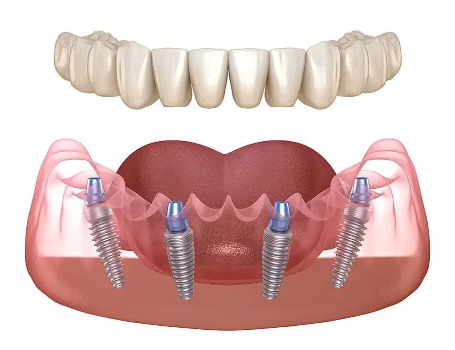 All on 4 Implante dentare Eart Dent
