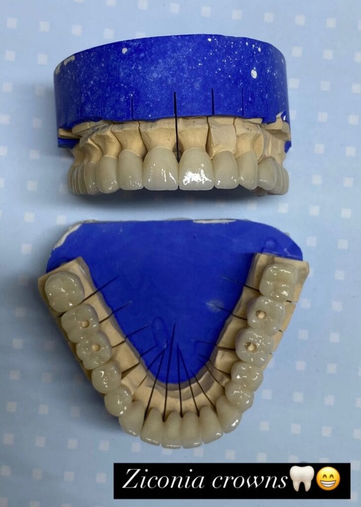 kurora-zirkoni-durres-klinike-dentare-eart-dent