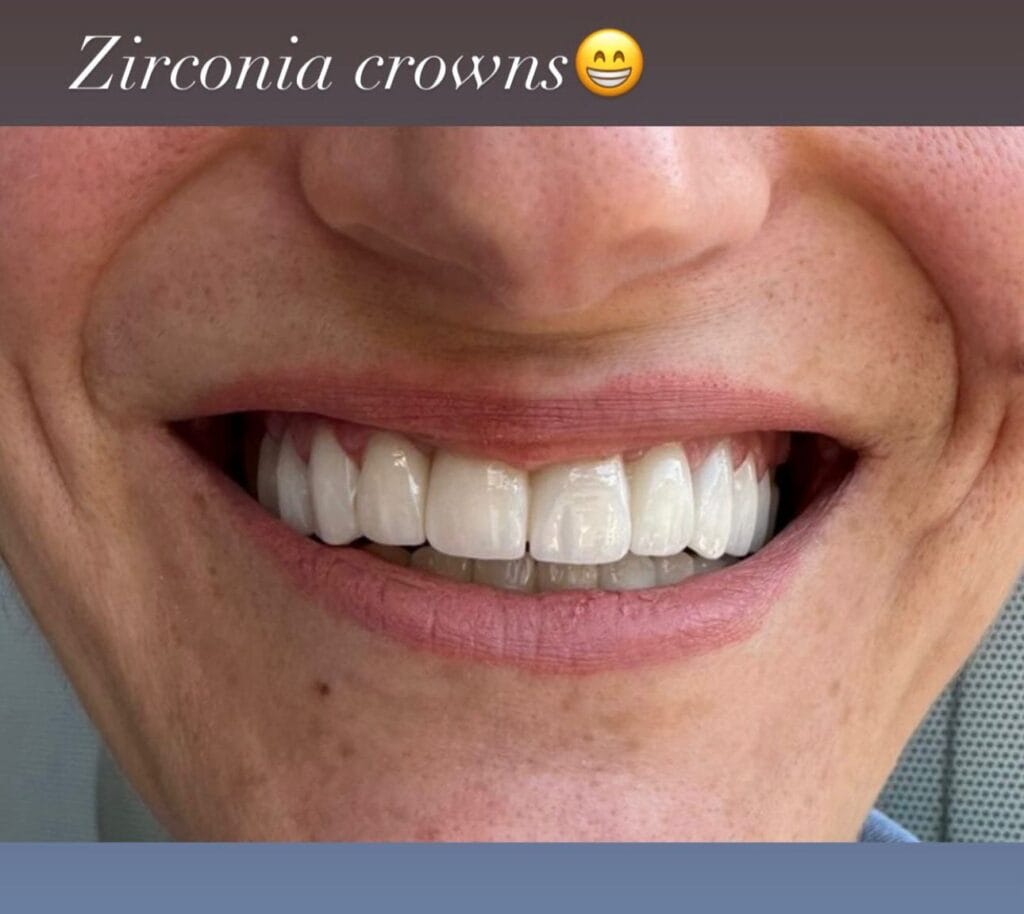 paciente-te-kenaqur-kurora-zirkoni-eart-dent