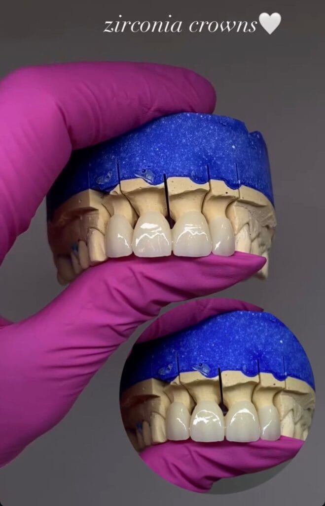 zirconia-crowns-durres-eart-dent