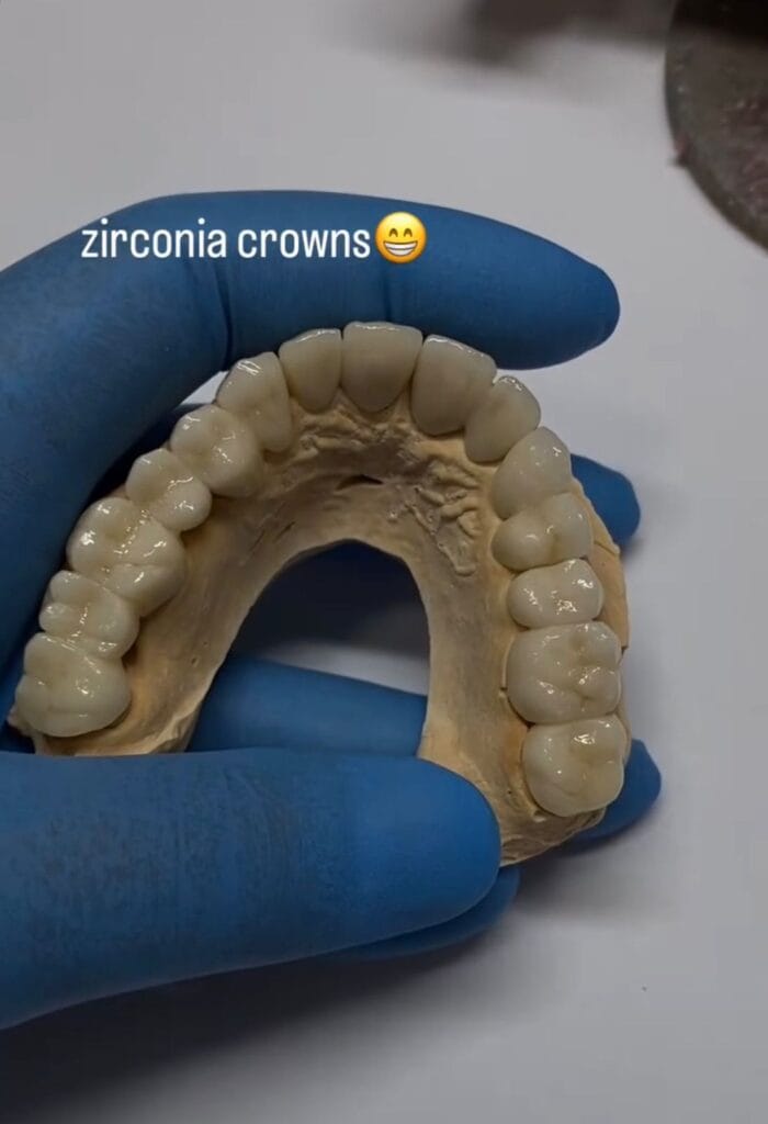zirconia-crowns-durres-klinike-dentare-eart-dent